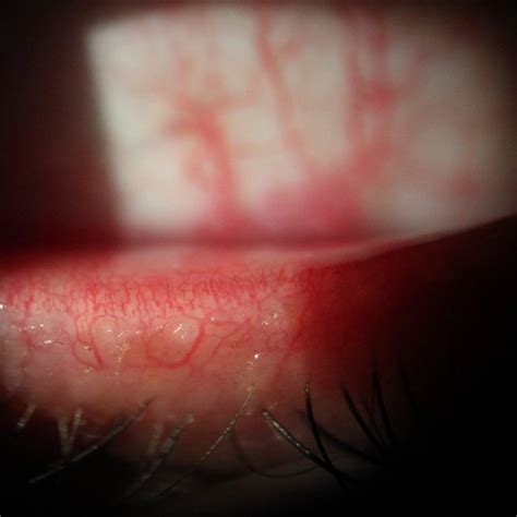 Anterior Blepharitis Photograph Depicts The Presence Of Brittle Scales