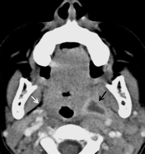 Axial Contrast Enhanced Ct In A Child With Acute Left Tonsillitis