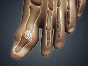 Conceptual image of gout in the big toe Gout is a form of inflammatory arthritis that causes ... Gout  