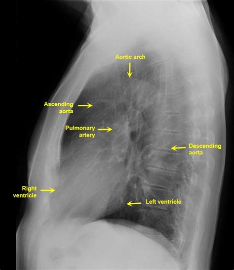 Normal Lateral Chest X Ray Male Online Image