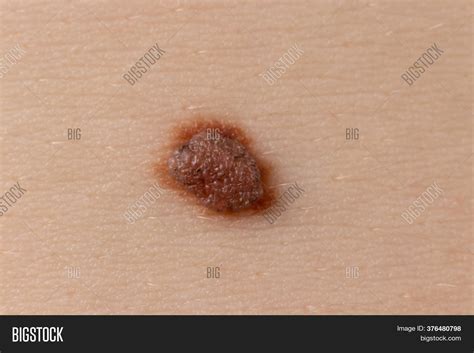 Mole Birthmark Nevus Image And Photo Free Trial Bigstock