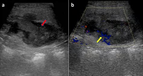cureus rare case of primary anterior abdominal wall abscess ultrasound ct and mri features