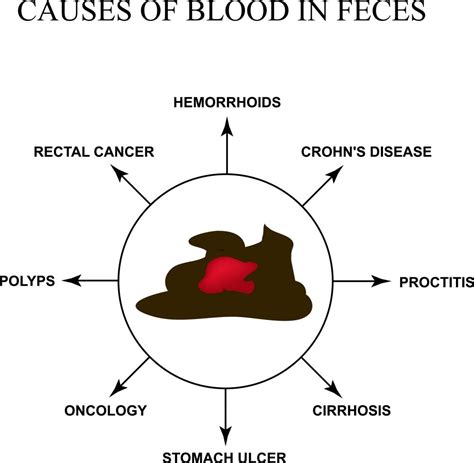 Causes Of Blood In Stool Stdgov Blog