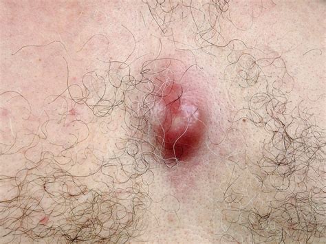 Sebaceous Cyst Stock Image C0402865 Science Photo