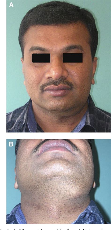 Figure 1 From Rapidly Growing Neck Swelling In The Submandibular