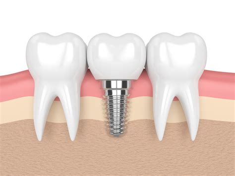 Why Choose A Single Tooth Dental Implant