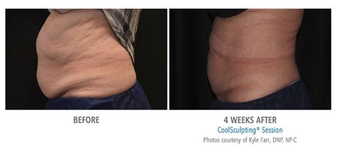 Is Coolsculpting® Right For Me Best Reflections