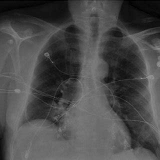 Post Embolization Chest Radiograph Indicating Coil Embolization In The