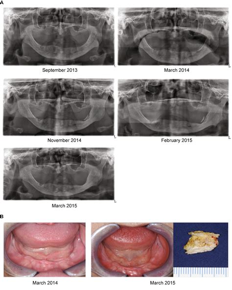Medication Related Osteonecrosis Of The Jaw Prevention Diagnosis And