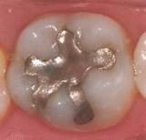 Dental Silver Fillings Images