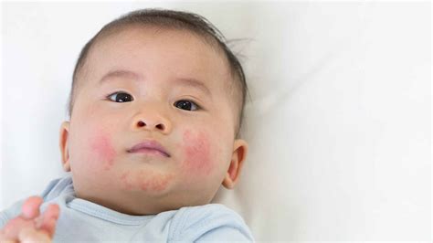 4 Cara Mengatasi Bintik Merah Pada Bayi Secara Alami Sensicare
