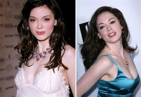 Celebrity Plastic Surgery Before After Photos