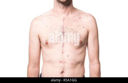 Some Scar From Open Heart Surgery In Studio Stock Photo Alamy