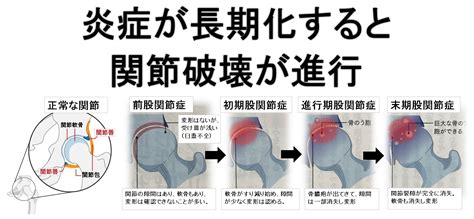 変形性股関節症 - 股関節「手術待った」股関節温存施術法