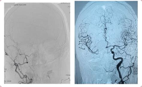 Left Cerebral 4 Vessel Angiography Post Ica Occlusion Aspect