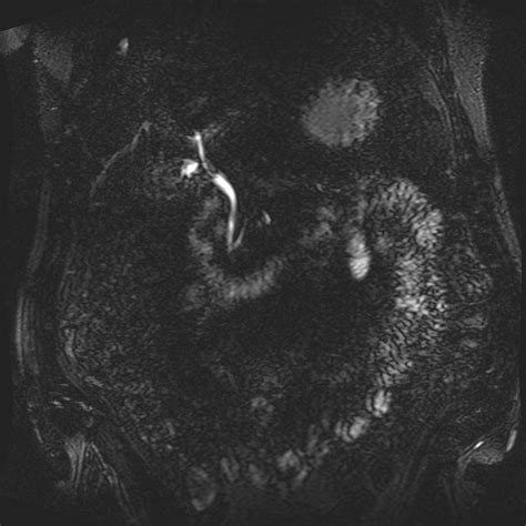 Paracaval Lipoma Image