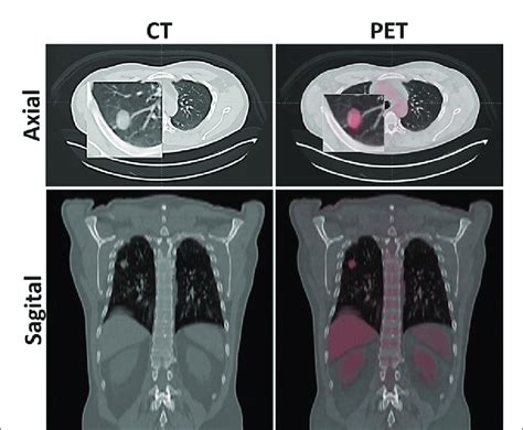 CT And PET CT Showing The Pulmonary Nodule Growth Verified In August Download Scientific