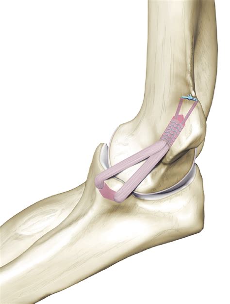 Docking Technique For Ulnar Collateral Ligament Reconstruction Figure Download Scientific