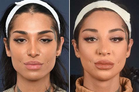 Jaw Reduction Feminizing The Jaw 2pass Clinic