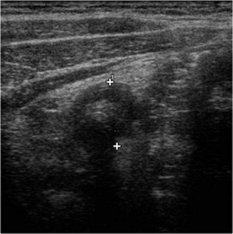 Ultrasound Features Of Appendicitis On The Axial Image We Valuated A