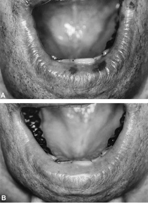 Simple Cryosurgical Treatment Of The Oral Melanotic Macule Oral
