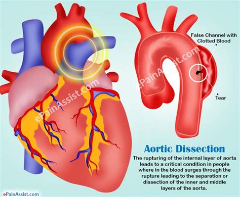 Aortic Dissectiontypescausessymptomstreatmentsurvival Rate