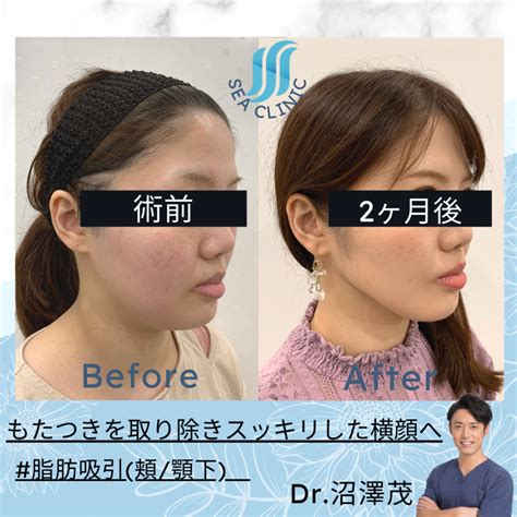 横顔も美しく～3d脂肪吸引～ Sea Clinic −シークリニック 銀座― 理想を叶える小顔治療