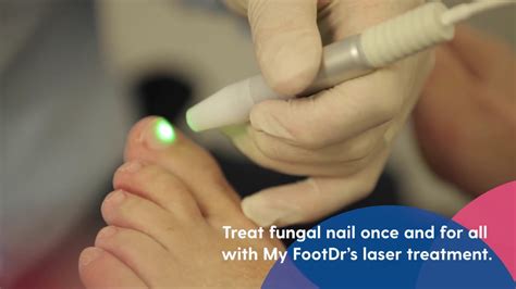 My Footdr Fungal Toenail Laser Treatment Youtube