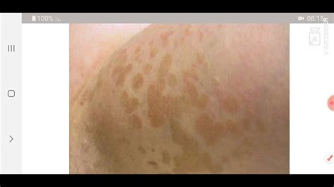 רפואת עור פטריית שמש Tinea Versicolor Youtube