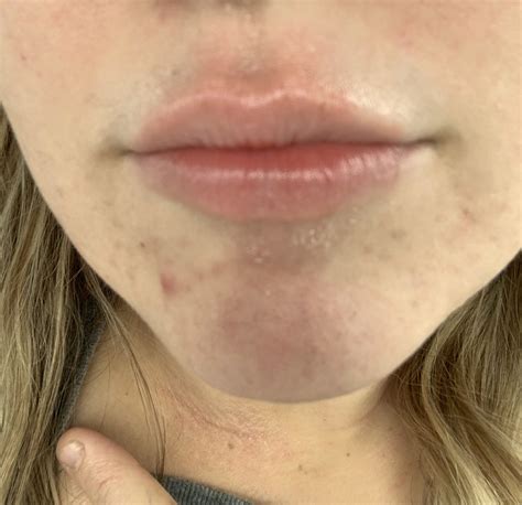 How I Cured My Lip Rash Cheilitis Eczema Contact Dermatitis Once
