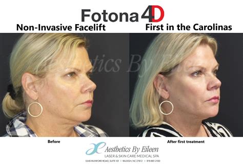 Fotona 4D Facial Aesthetics By Eileen