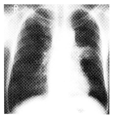 Figure 1 From An Autopsy Case Of Lung Cancer Presenting Symptoms Of