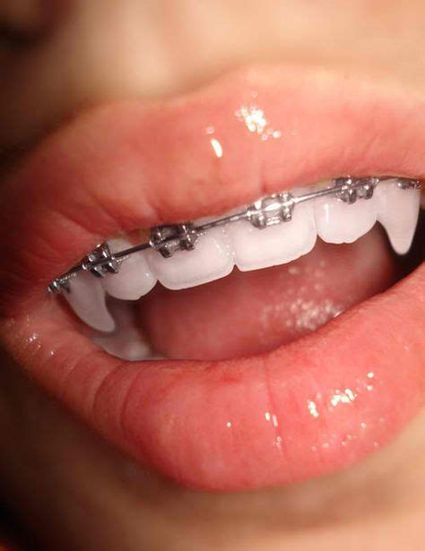 7 ideas de braces brackets dentales ligas para brackets frenillos dentales