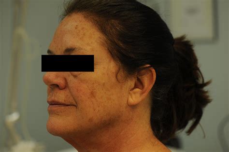 Co2 Laser Skin Resurfacing Treatment Skin And Laser Surgery Center Of