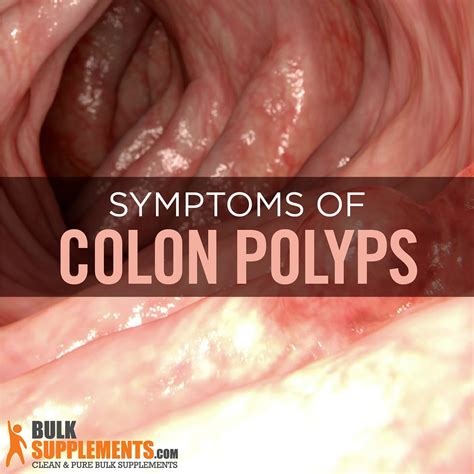 Colon Polyps Symptoms Causes And Treatment Science Connecting Medium