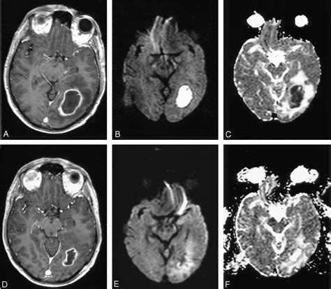 Diffusion Weighted Imaging In The Assessment Of Brain Abscesses Therapy