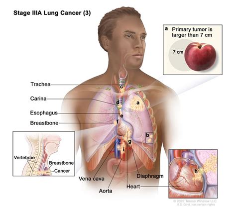 Non Small Cell Lung Cancer Vanderbilt Ingram Cancer Center