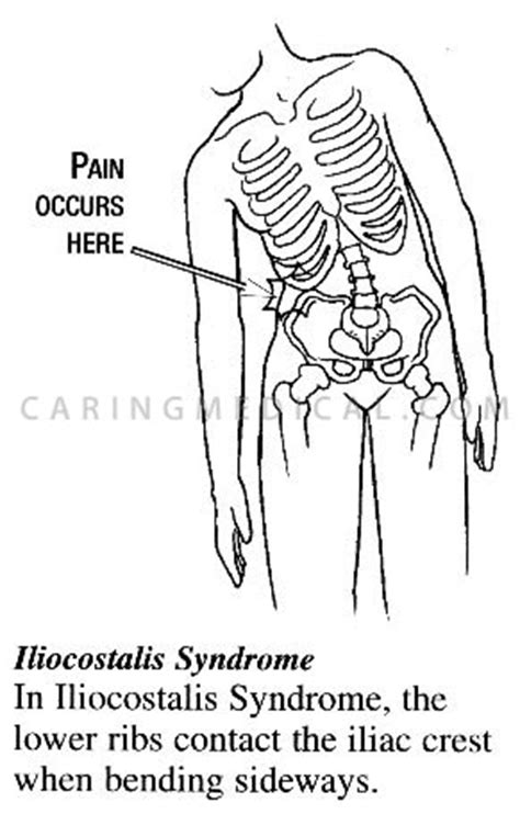Pain in the lower right abdomen near the hip bone can be caused by many conditions, ranging from indigestion to potential emergencies, such as appendicitis. Prolotherapy for Iliocostalis Syndrome - Caring Medical ...