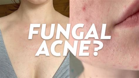 5 Tips On How To Treat Fungal Acne On Your Face Effectively