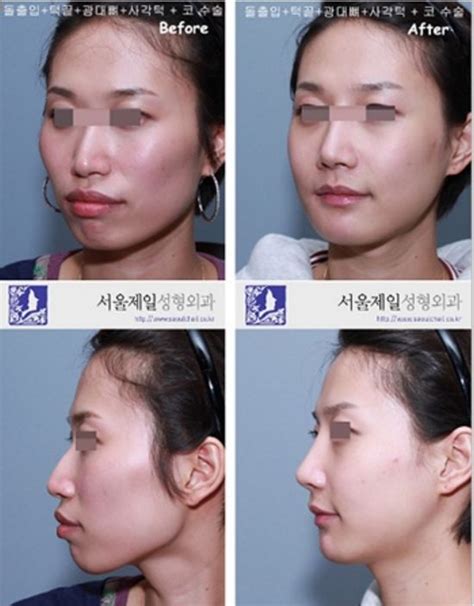 Crazy Before And After Photos Of South Korean Plastic Surgery Page 4