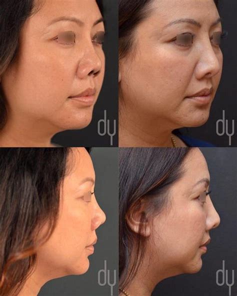Asian Rhinoplasty In Phillipines Before And After Rhinoplasty Cost Pics Reviews Q A