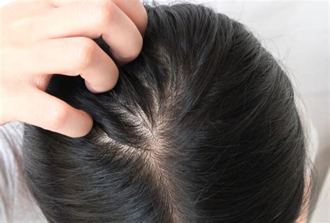 Itchy Scalp Causes Treatment And When To See A Doctor