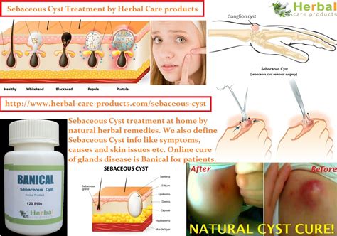 10 Natural Remedies For Sebaceous Cyst Herbal Care