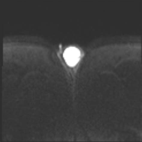 Testicular Atrophy Unilateral Image Radiopaedia Org