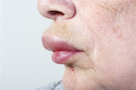 Face Swelling Causes Treatment And When To See A Doctor