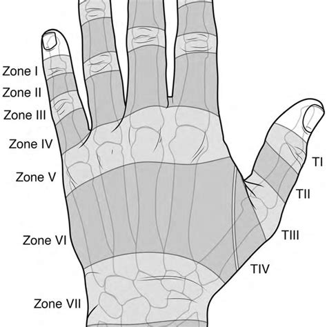 Zones Of Extensor Tendon Injury In The Hand This Article Focuses On