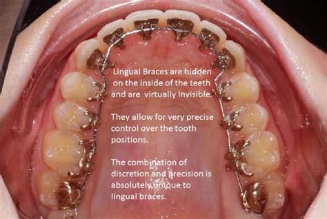 The Benefits Of Lingual Orthodontics Clonmel Orthodontics Blog