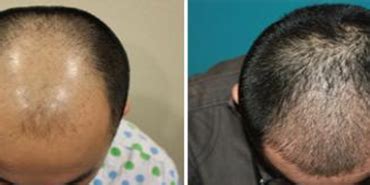 We understand that taking the first step to do a hair transplant procedure is is a big decision for you. Hair Transplant in Malaysia - Cost and Reviews- Nexus Clinic