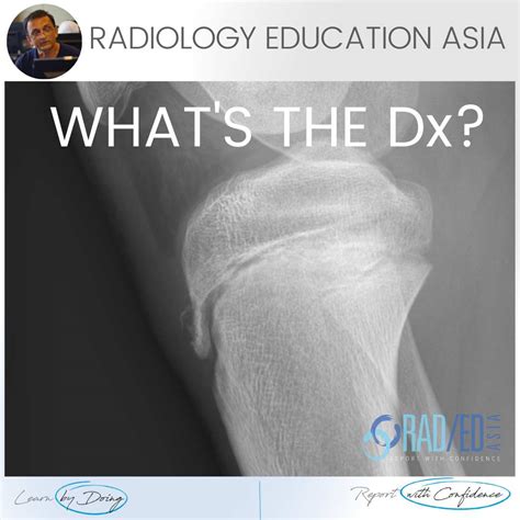 Osgood Schlatter Radiology X Ray Video Radedasia