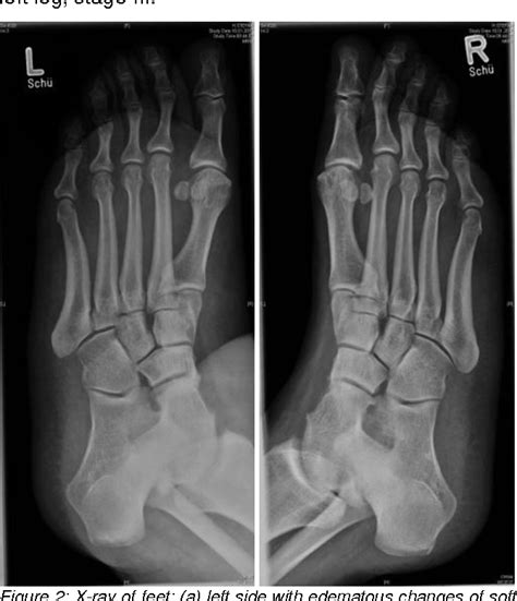 Hereditary Lymphedema Of The Leg A Case Report Semantic Scholar